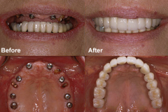 implants-dental